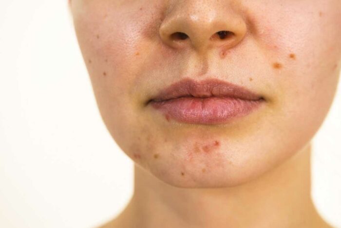 El acné es una inflamación de ciertos órganos de la piel causada por diferentes razones.