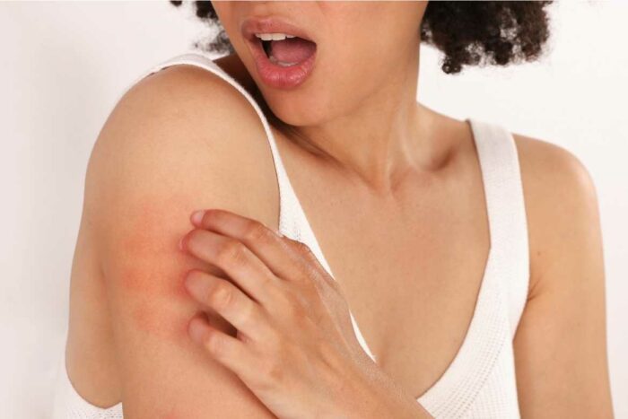 Los síntomas de alergias en la piel se pueden observar a través de la urticaria.