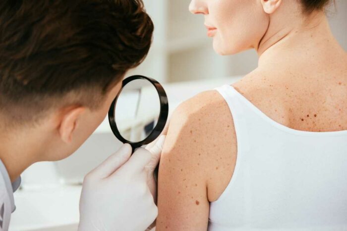 El cáncer de piel o melanoma se forma a partir de células de la piel distintas a los melanocitos.