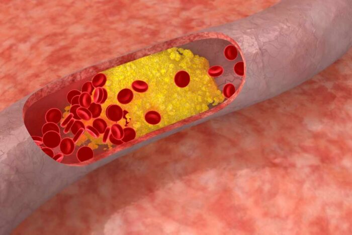 Cuando el colesterol circula en exceso, puede ocasionar el endurecimiento de las paredes de las arterias, lo que puede desencadenar