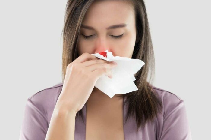 La hemorragia nasal es la pérdida de sangre del tejido que recubre la nariz, y generalmente ocurre con más frecuencia en una fosa únicamente.