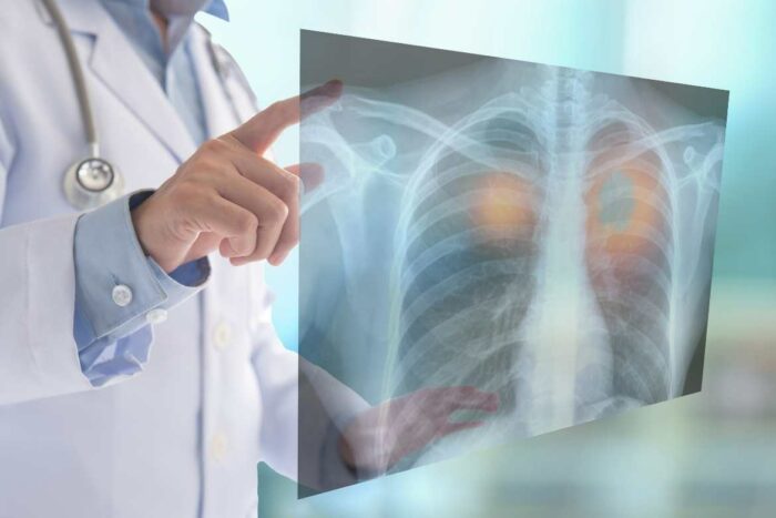 El cáncer de pulmón es la principal causa de muerte por cáncer tanto en hombres como mujeres.