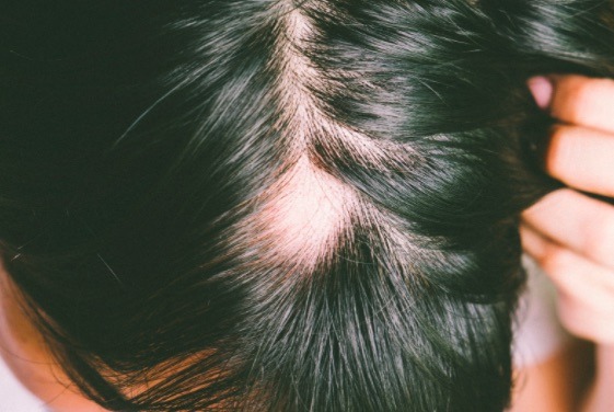 la alopecia areata puede dejar zonas del cabello totalmente calvas