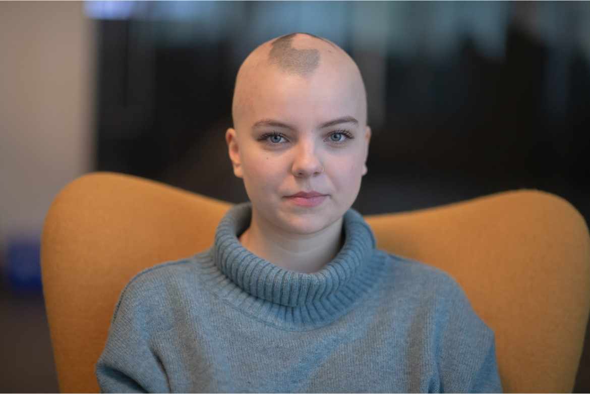 Porqué la alopecia areata afecta a mujeres y cómo tratarla