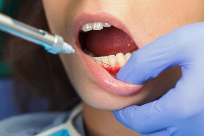 Otra razón para atender más la higiene bucal son las enfermedades dentales como la gingivitis
