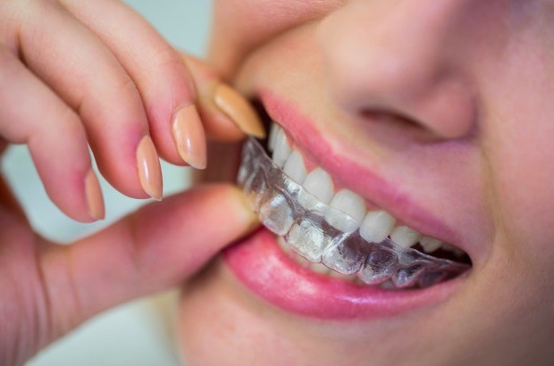 La odontología cosmética cuenta con diferentes procedimientos para lograr un diseño de sonrisa perfecto