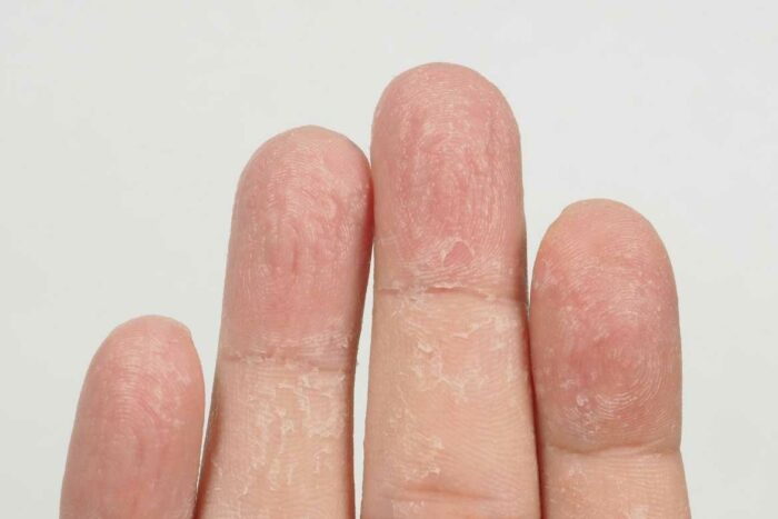 El principal efecto por usar uñas postizas es una dermatitis de contacto en la piel de alrededor de las uñas