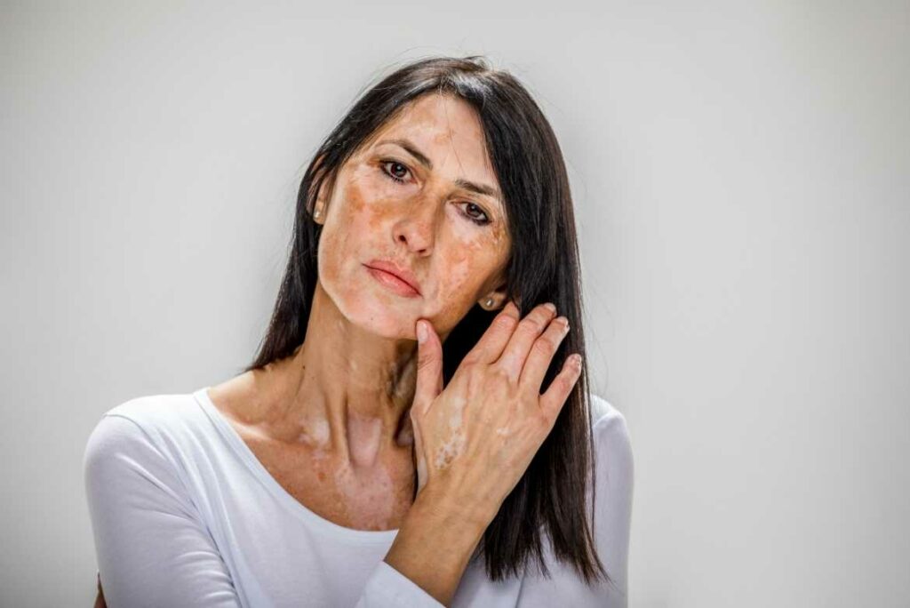 Vitiligo: por qué la piel pierde su color y cómo tratarlo, según experto