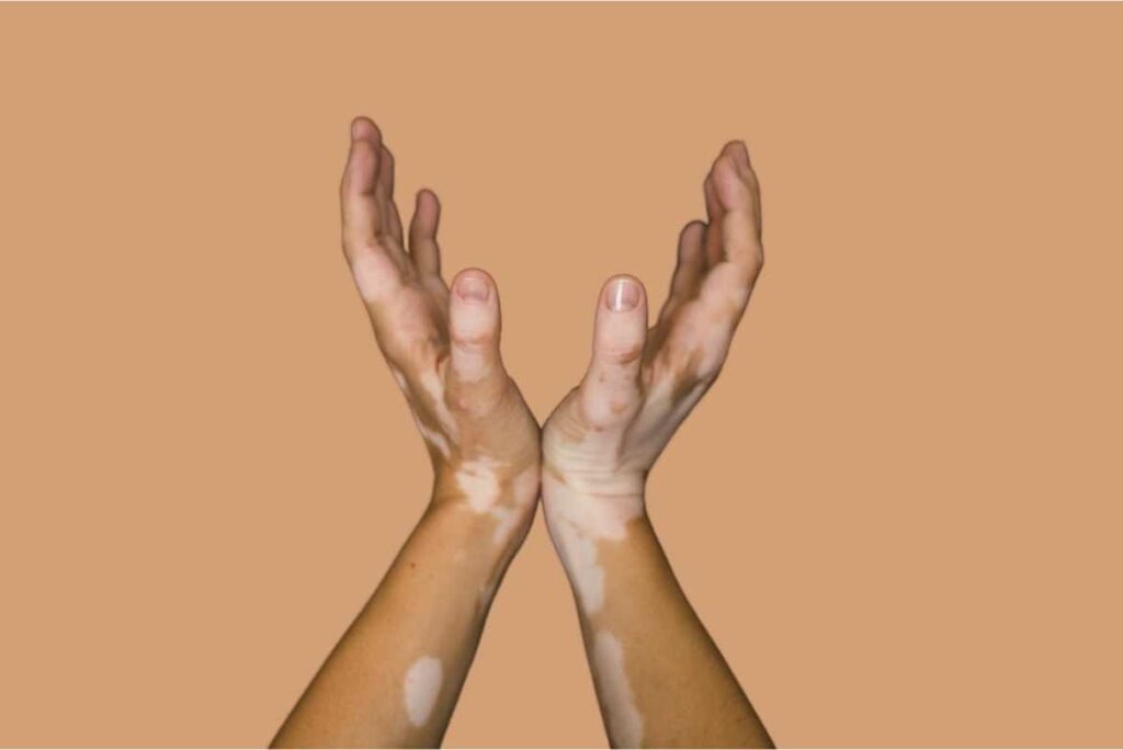 El vitiligo se presenta generalmente con manchas pequeñas en la piel, que se agrandan con el paso del tiempo, y puede afectar a personas de cualquier edad,
